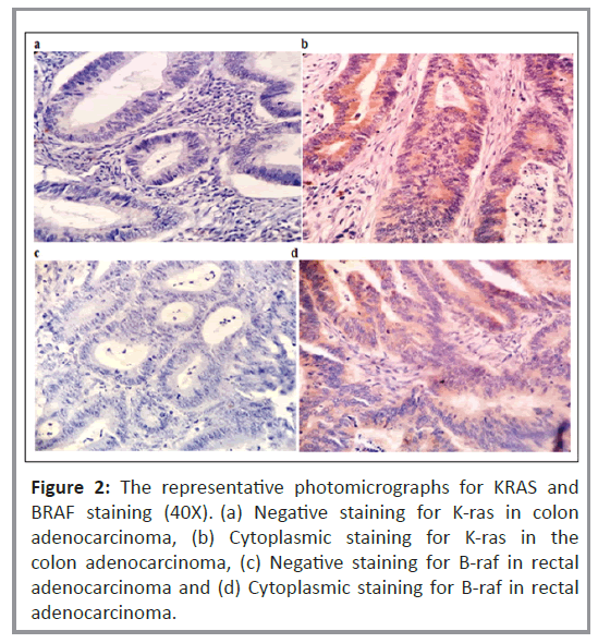 colorectal-cancer-photomicrographs