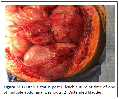 ipcco-Uterus
