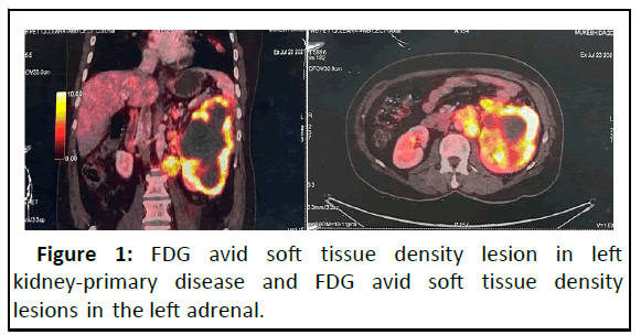 ipmo-FDG