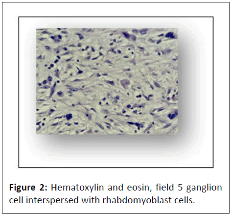 journal-of-neoplasm-hematoxylin