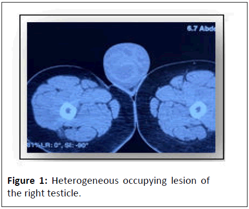 journal-of-neoplasm-heterogeneous