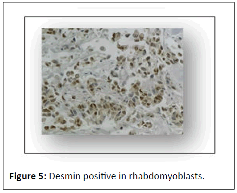 journal-of-neoplasm-rhabdomyoblasts