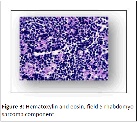 journal-of-neoplasm-rhabdomyosarcoma