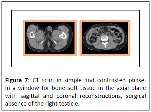 journal-of-neoplasm-right-testicle