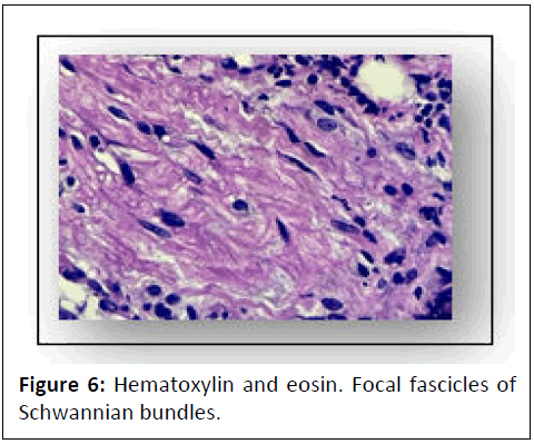 journal-of-neoplasm-schwannian