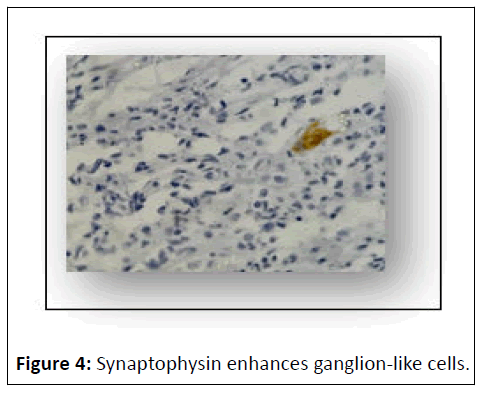 journal-of-neoplasm-synaptophysin