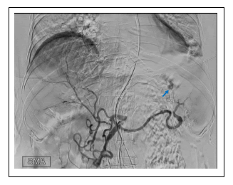 medical-case-angiography