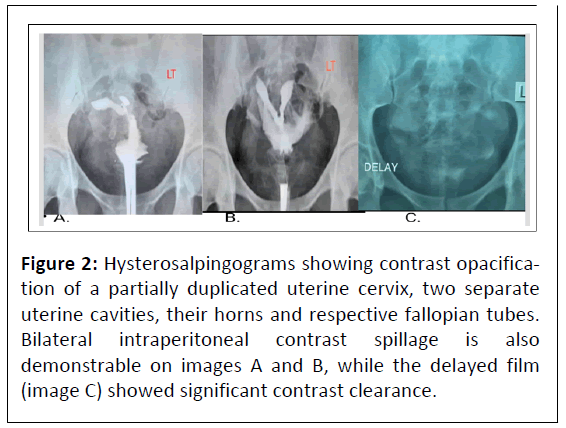 medical-case-hysterosalpingograms