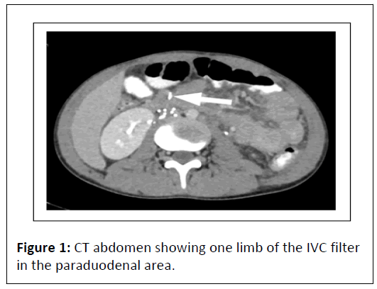 medical-case-paraduodenal