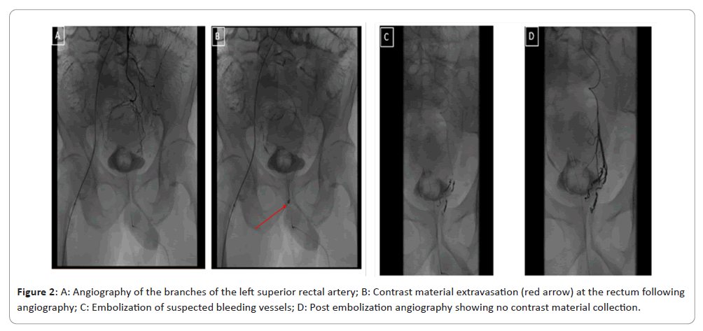 international-journal-material-extravasation