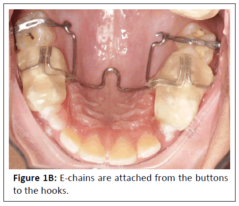 orthodontics-e-chains