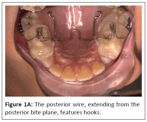 orthodontics-posterior-wire