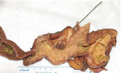 Pancreaticoduodenectomy