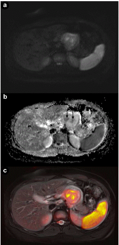 pancreas