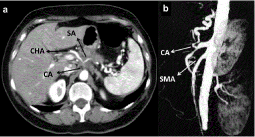 tumor