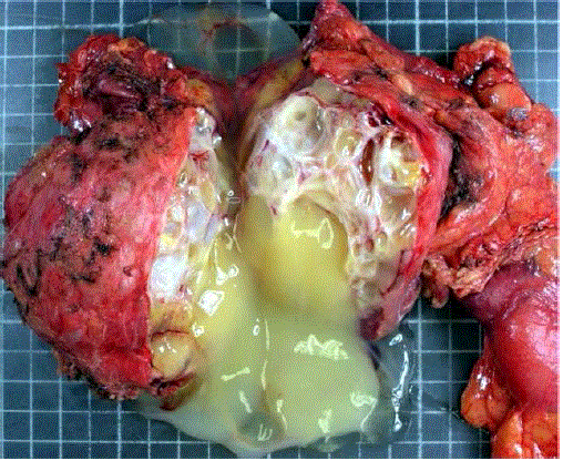 pancreaticoduodenectomy