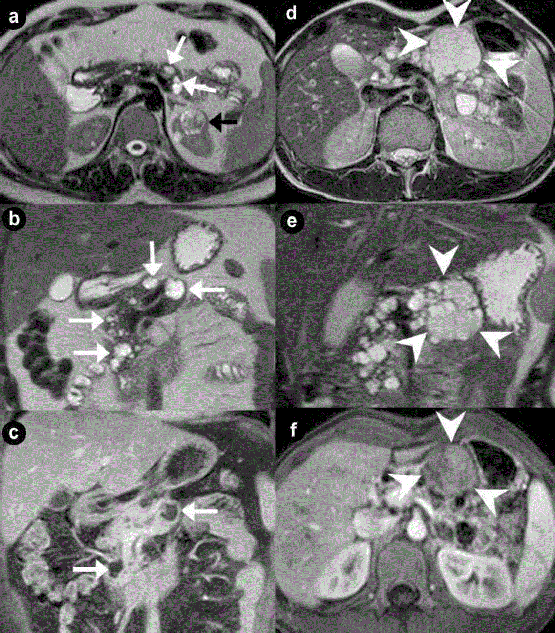 Pancreatic