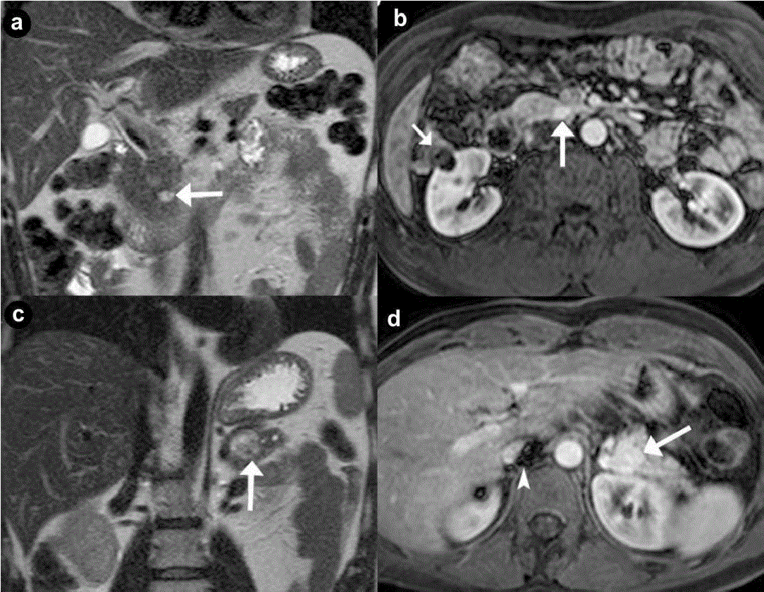 Pancreatic