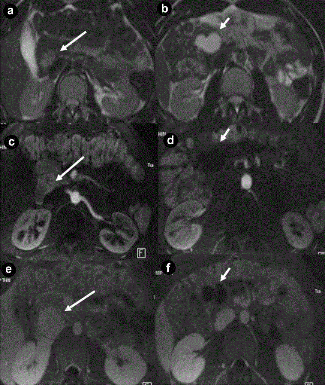 Pancreatic