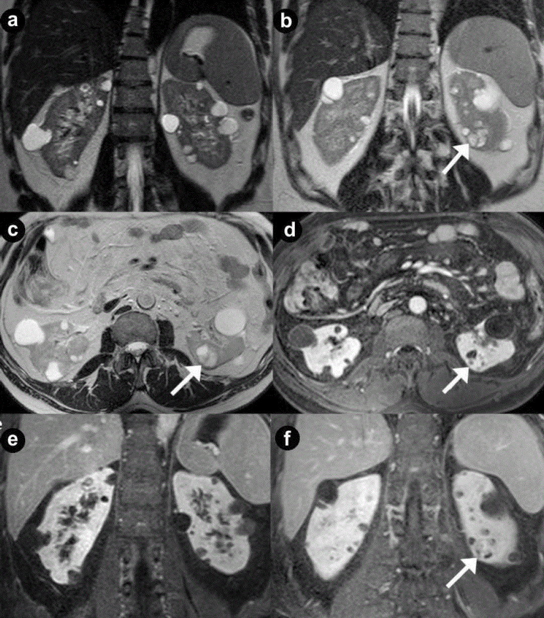 Pancreatic