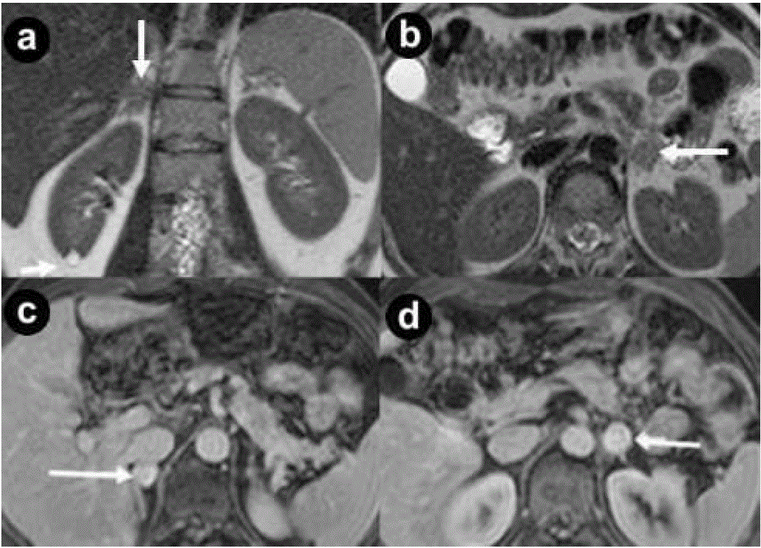 Pancreatic