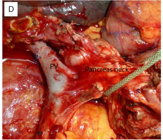 posterolateral