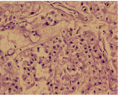 carcinoma