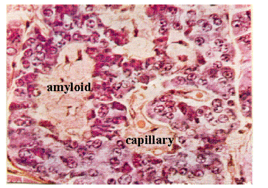 amyloid