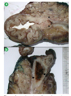 adenocarcinoma