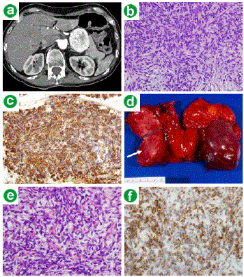 pancreatic