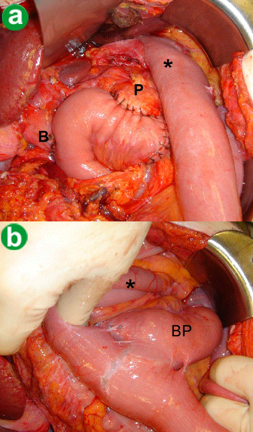 stricture