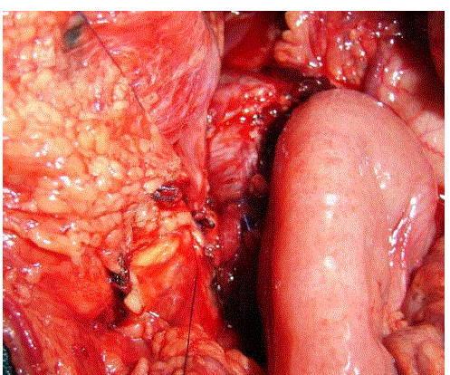 pancreas