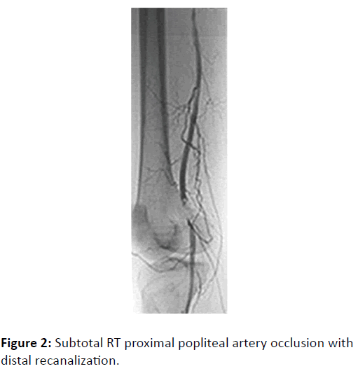 Preventive-Medicine-proximal-popliteal-artery