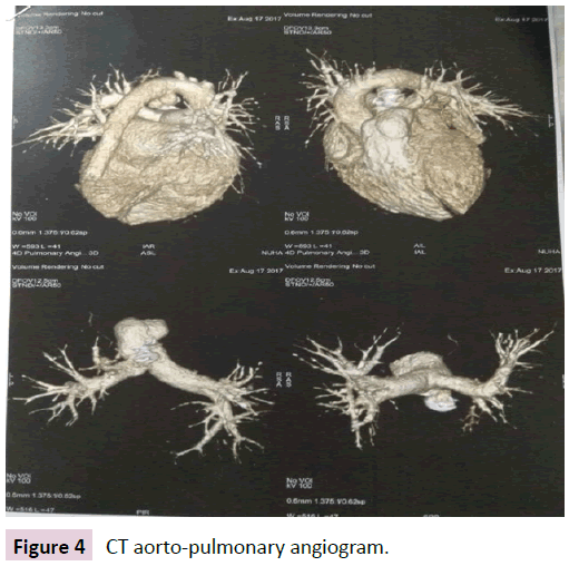 birth-defects-CT-aorto-pulmonary