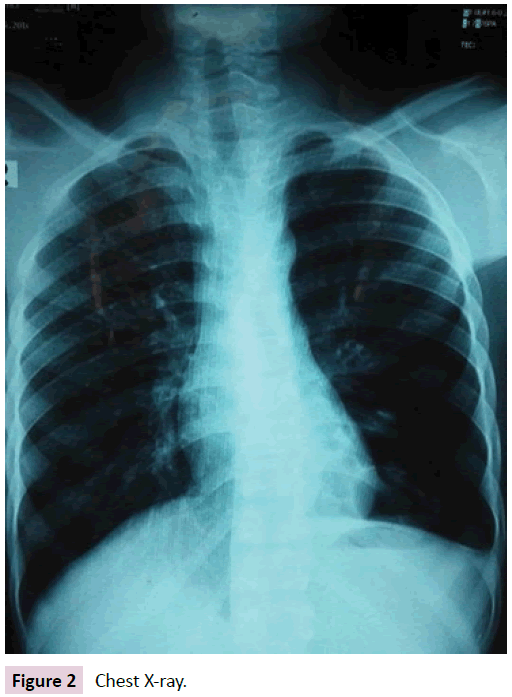 birth-defects-Chest-X-ray