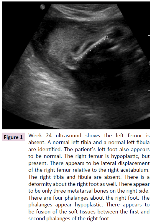 birth-defects-second-phalanges-right-foot