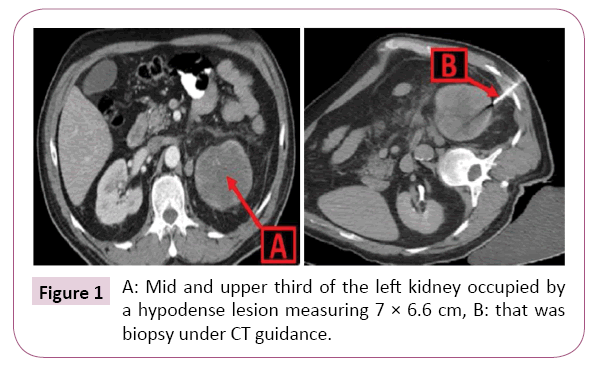 cancer-biology-and-therapeutic-oncology-kidney