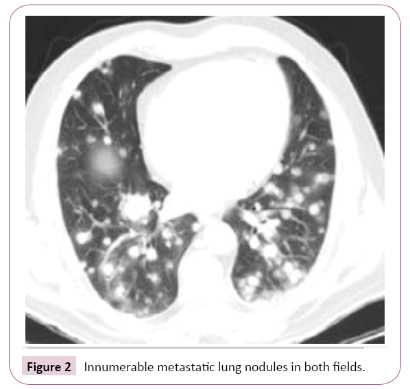 cancer-biology-and-therapeutic-oncology-nodules