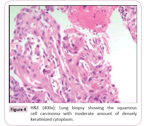 cancer-biology-and-therapeutic-oncology-squamous