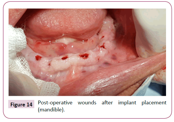 clinical-medicine-therapeutics-implant-placement