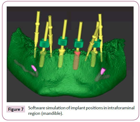 clinical-medicine-therapeutics-implant-positions