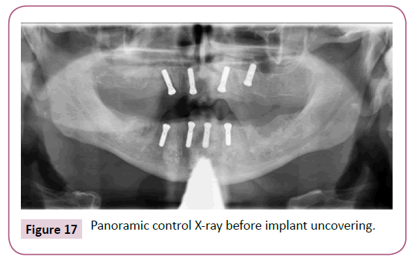 clinical-medicine-therapeutics-implant-uncovering