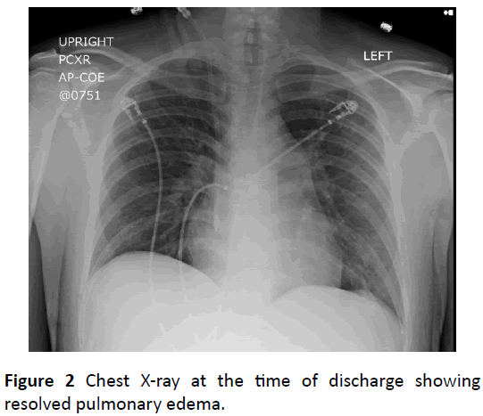 clinical-medicine-therapeutics-pulmonary-edema