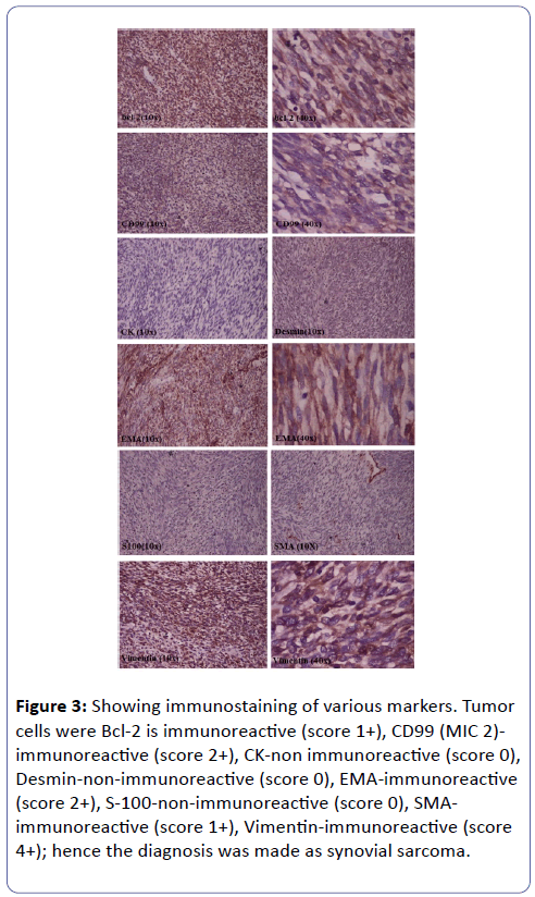 clinical-molecular-pathology-Vimentin-immunoreactive