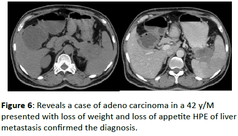 clinical-radiology-adeno-carcinoma