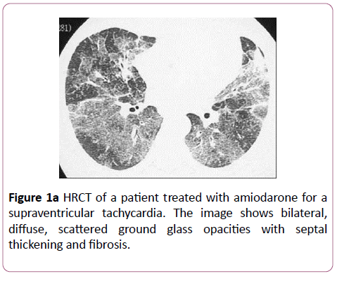 clinical-radiology-case-reports-amiodarone