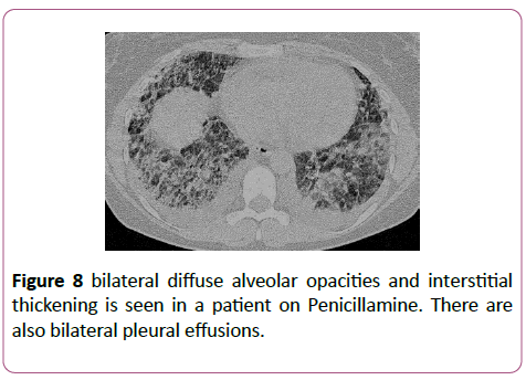 clinical-radiology-case-reports-bilateral