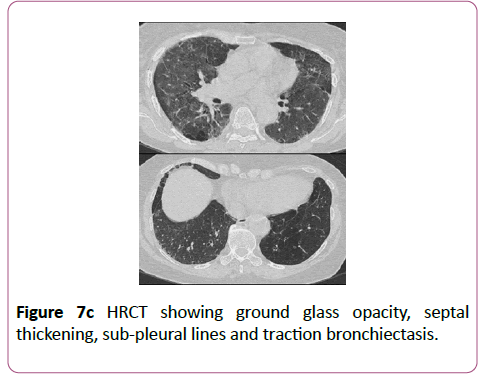 clinical-radiology-case-reports-bronchiectasis