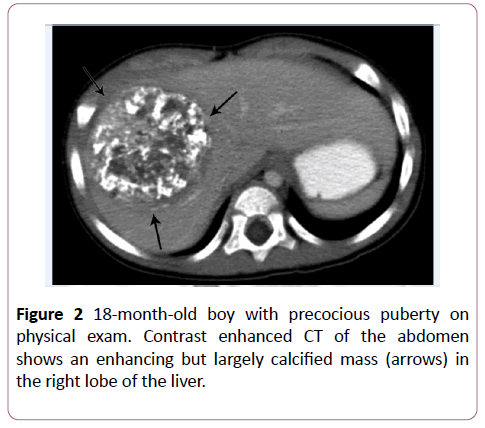 clinical-radiology-case-reports-calcified