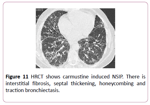 clinical-radiology-case-reports-carmustine